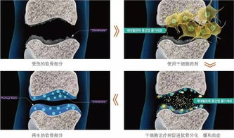 韩国cartistem干细胞治疗膝关节炎